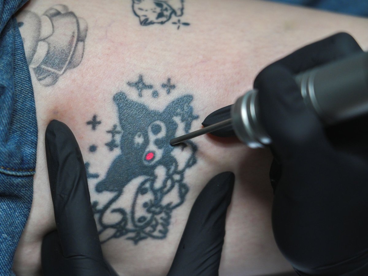 laser removal does not leave scars