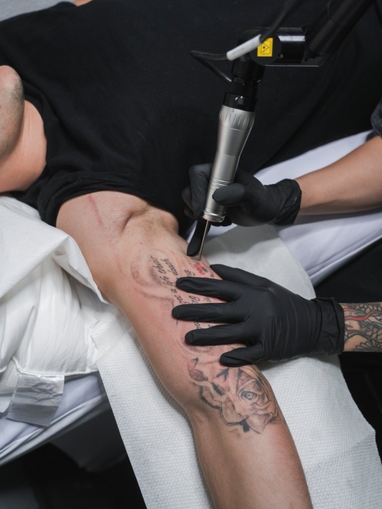 tattoo removal in san antonio