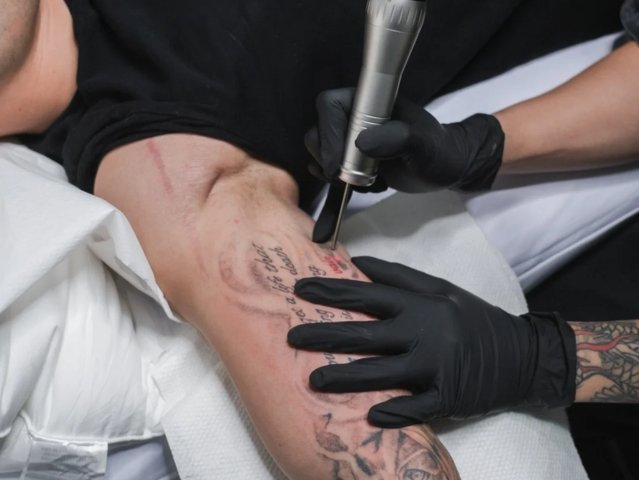 Tattoo Removal in San Antonio Texas