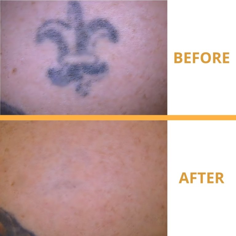 tattoo removal result
