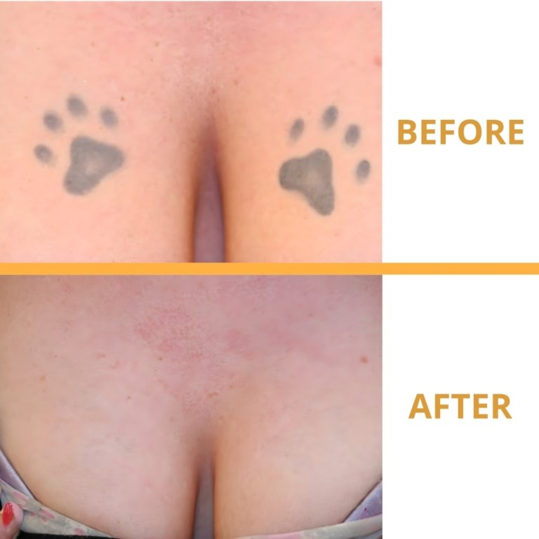 tattoo removal result