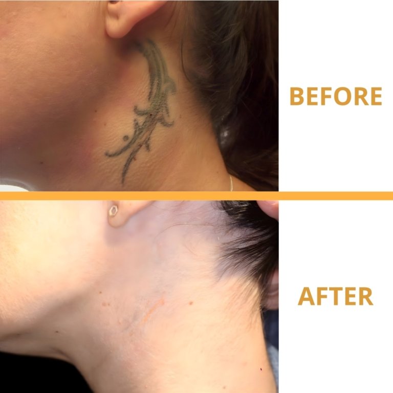 tattoo removal result