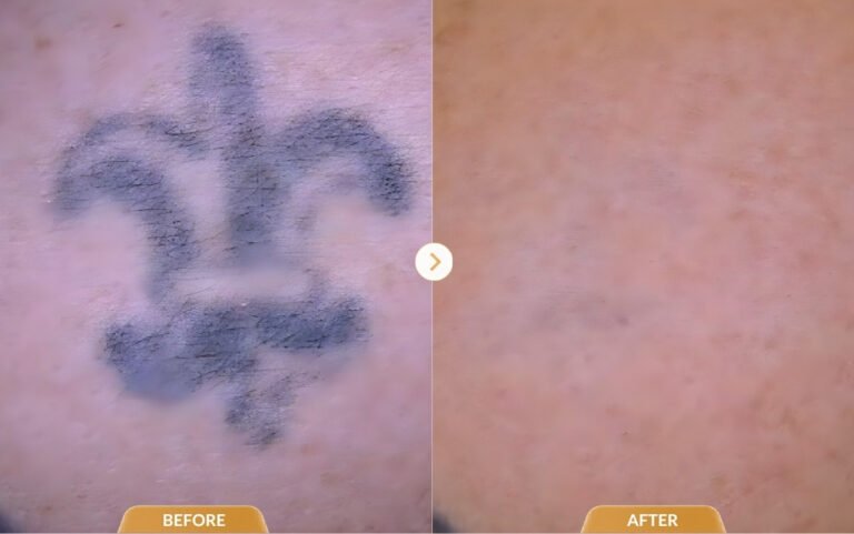 Tattoo removal results