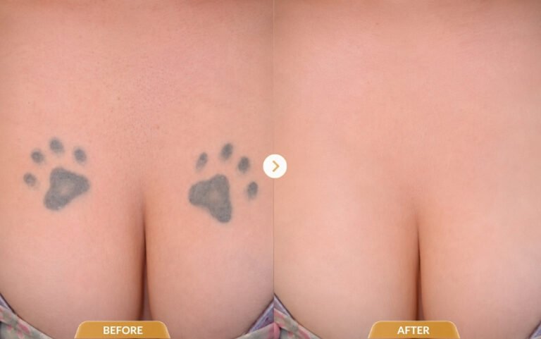 Tattoo removal results