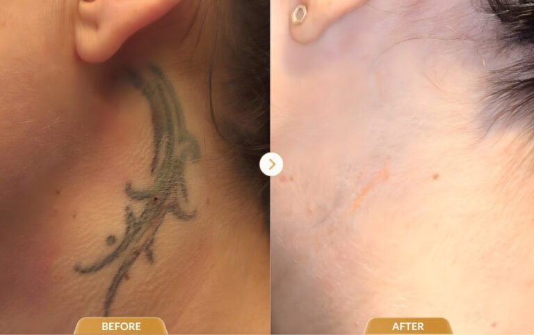 Tattoo removal results