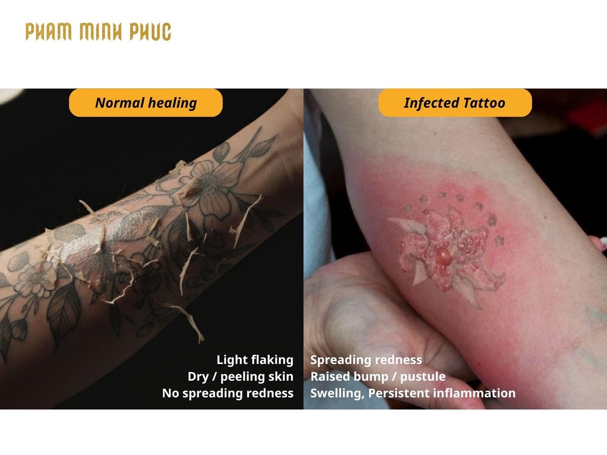 Normal healing tattoo compared with infected tattoo showing redness swelling and pus